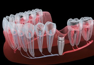 Illustration of implant placed in gum tissue