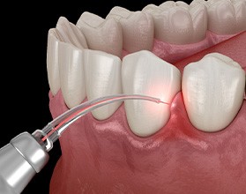 a computer illustration showing laser gum disease treatment