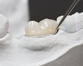 A closeup of a dental crown set on a cast model