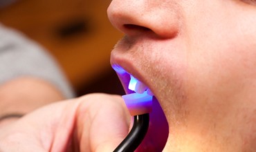 Man having dental bonding procedure