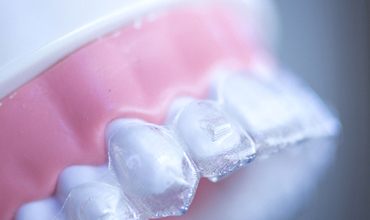 Clear aligner over dental mold.