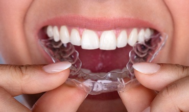 Woman inserting clear aligner.