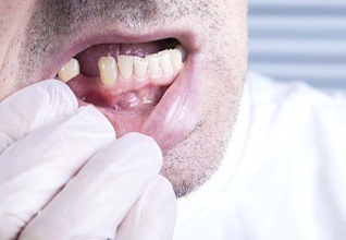 Man with a missing lower tooth