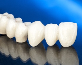 All-ceramic dental bridge