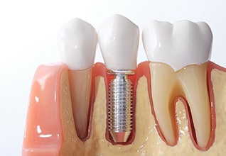 model of a single dental implant in the jaw