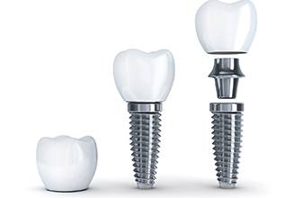 dental implant post, abutment, and crown
