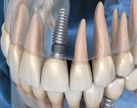 dental implant in the upper jaw