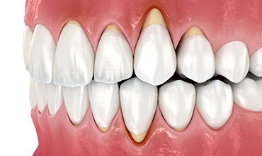 Illustration of receding gums