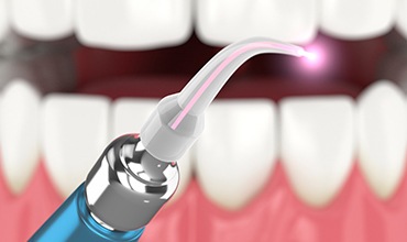 Illustration of dental laser