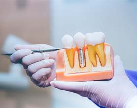Dentist holding model of dental implant in Chevy Chase