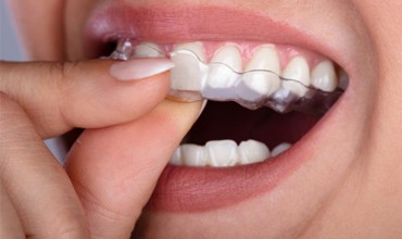 person inserting Invisalign clear braces 