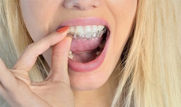 girl inserting Invisalign clear aligner 