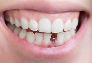 Smile with dental implant