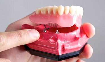 implant-retained dentures 