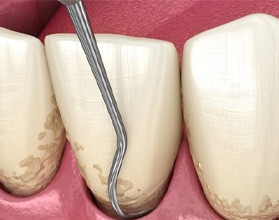 a 3 D illustration of scaling and root planing 