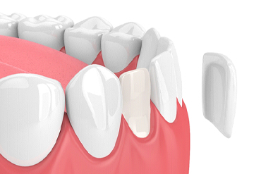 Digital model of dental veneers in Chevy Chase next to a tooth.