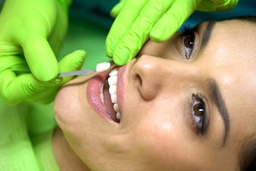 dentist placing a dental veneer