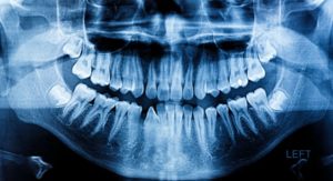 An X-Ray of a patient’s mouth.