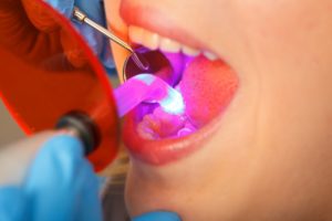 woman receiving direct bonding from dentist