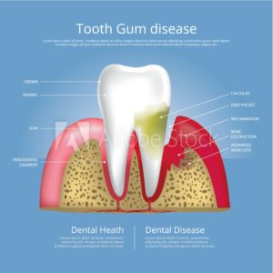 Illustration of a tooth with gum disease