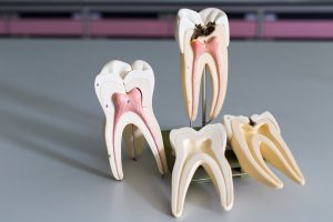 Root canal educational model