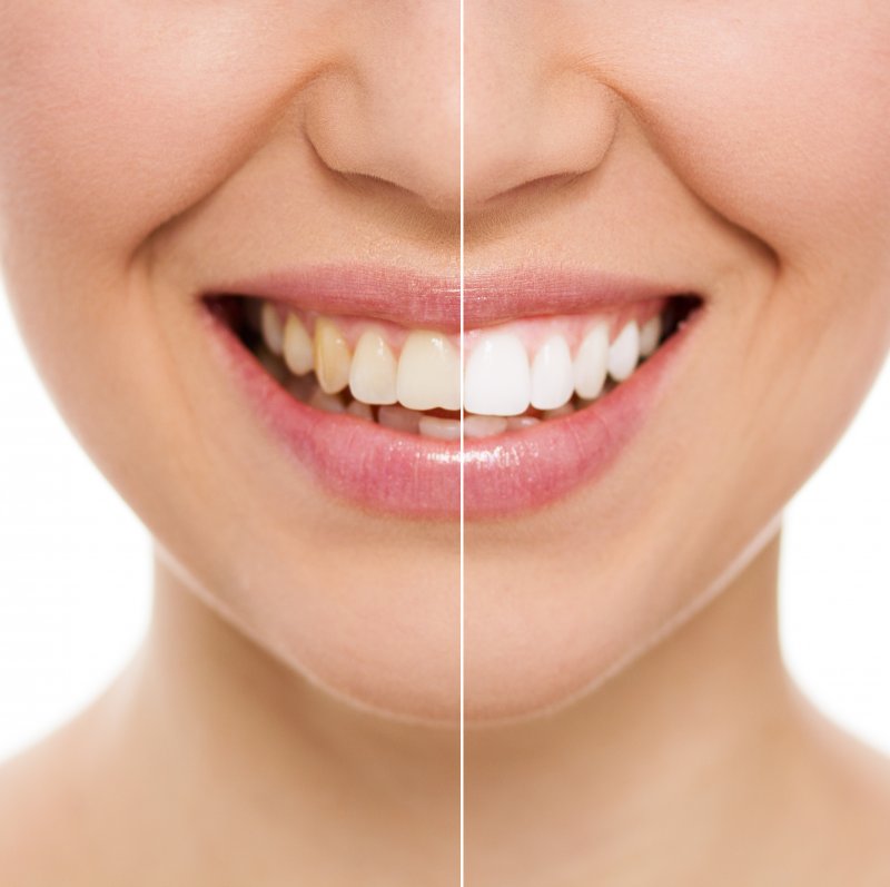 woman teeth whitening before and after