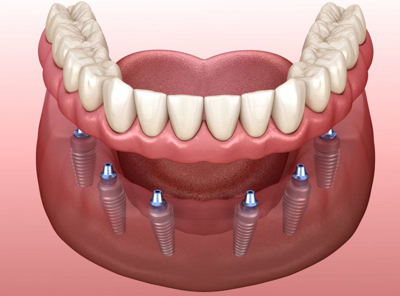 a digital image of a bottom arch with a customized denture being placed over six dental implants that are inserted into the jawbone