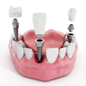 What is the Latest Dental Technology  