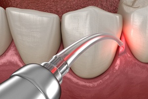 Soft tissue laser for gum disease therapy