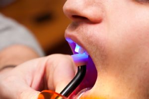 a dentist holding an ultraviolet light up to a tooth to cure composite resin