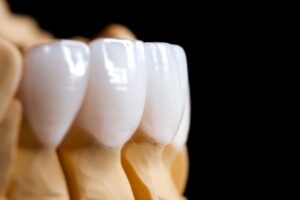 Veneers in close-up. 